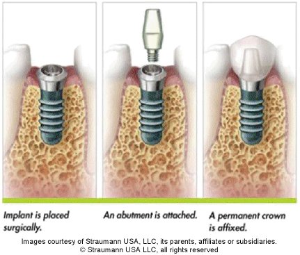 Dental Implants (3D CBCT Guided)
