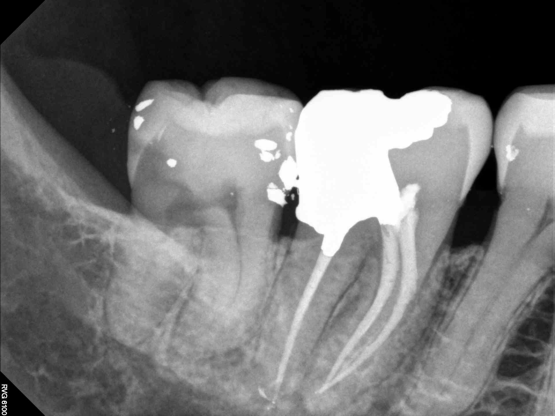 Deep Caries & Endodontic Protection