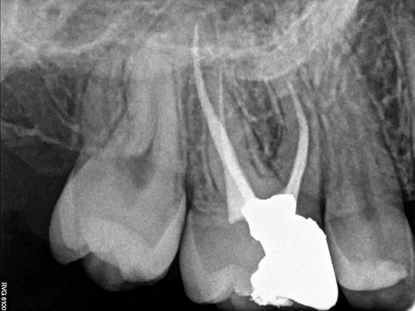 Anterior Aesthetic Endodontic Seal