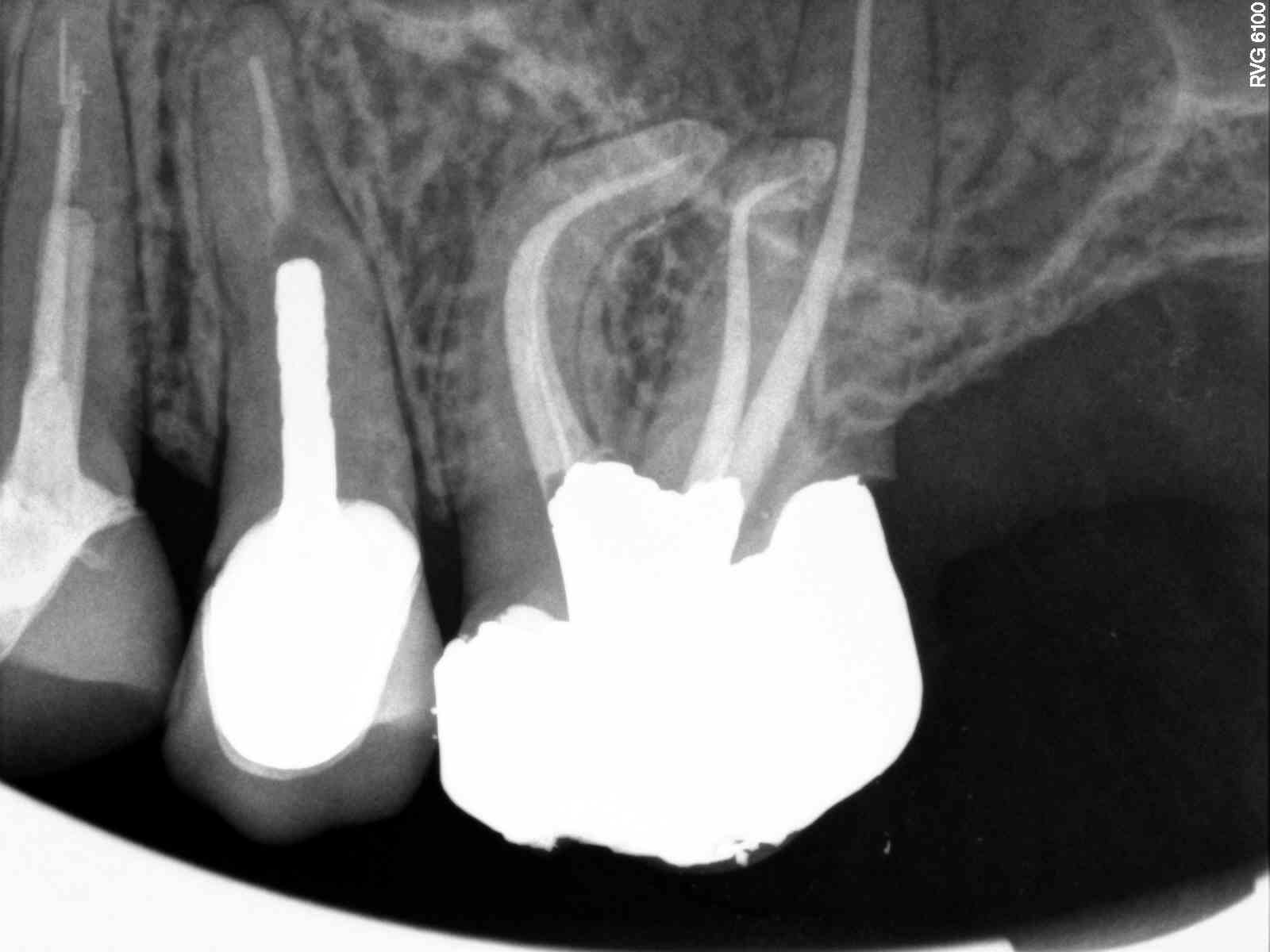 Premolar Dual-Canal Endodontics