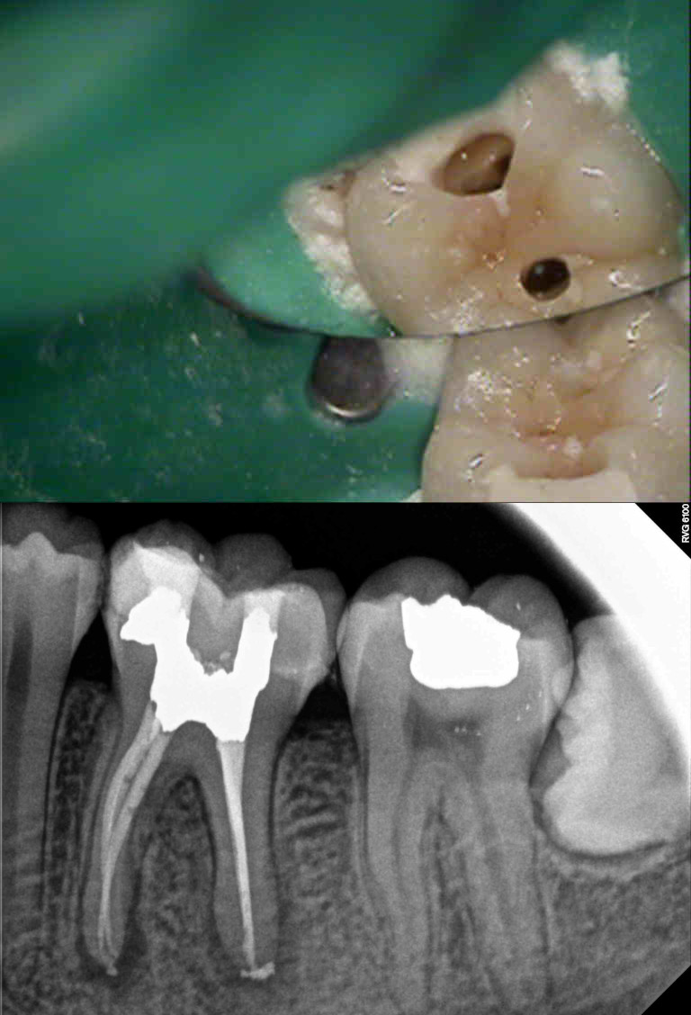 Molar Apical Healing