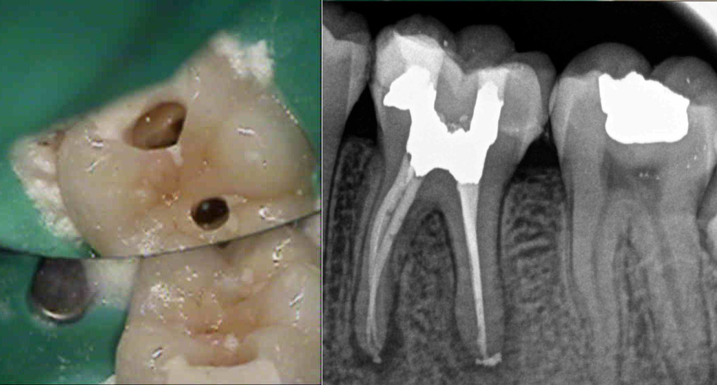 Follow-up Radiograph (1 Year)