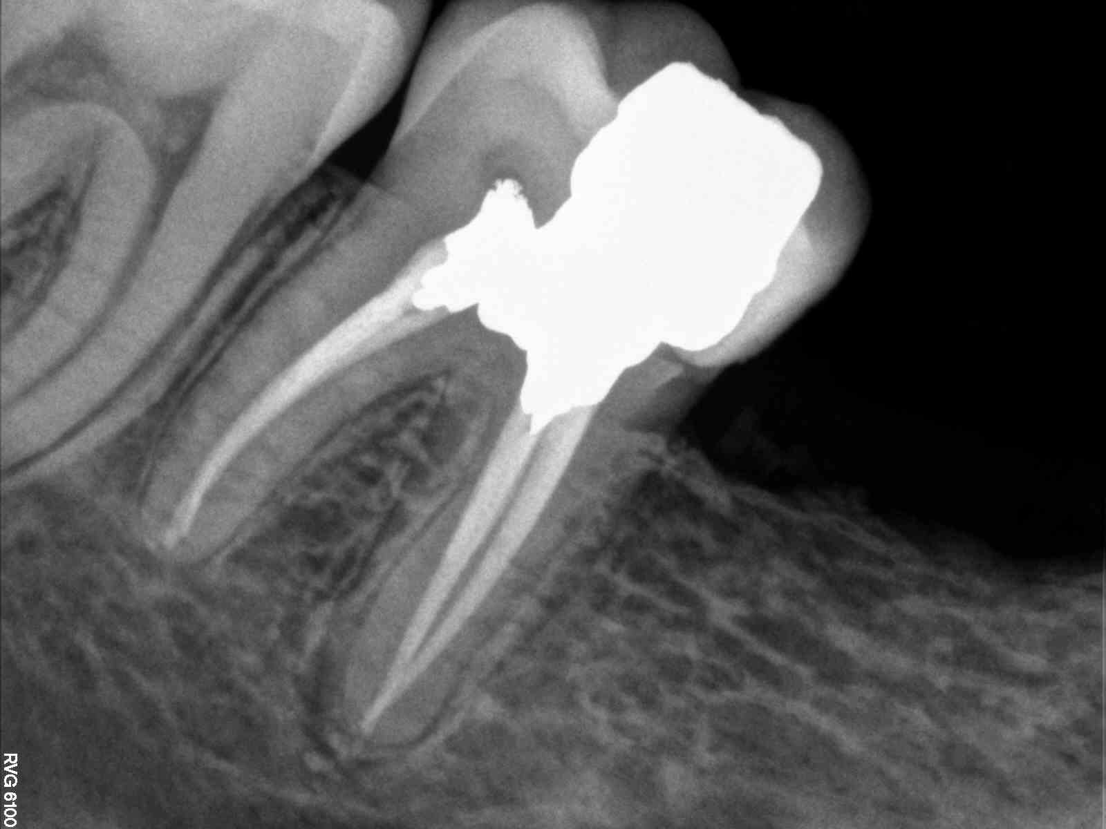 Lower Molar Retreatment