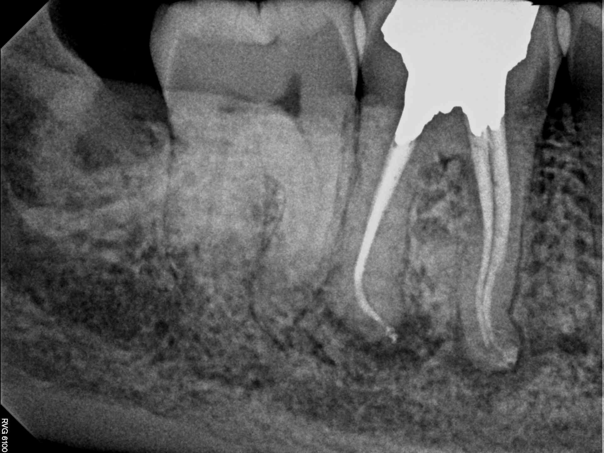 Post & Core Endodontic Restoration