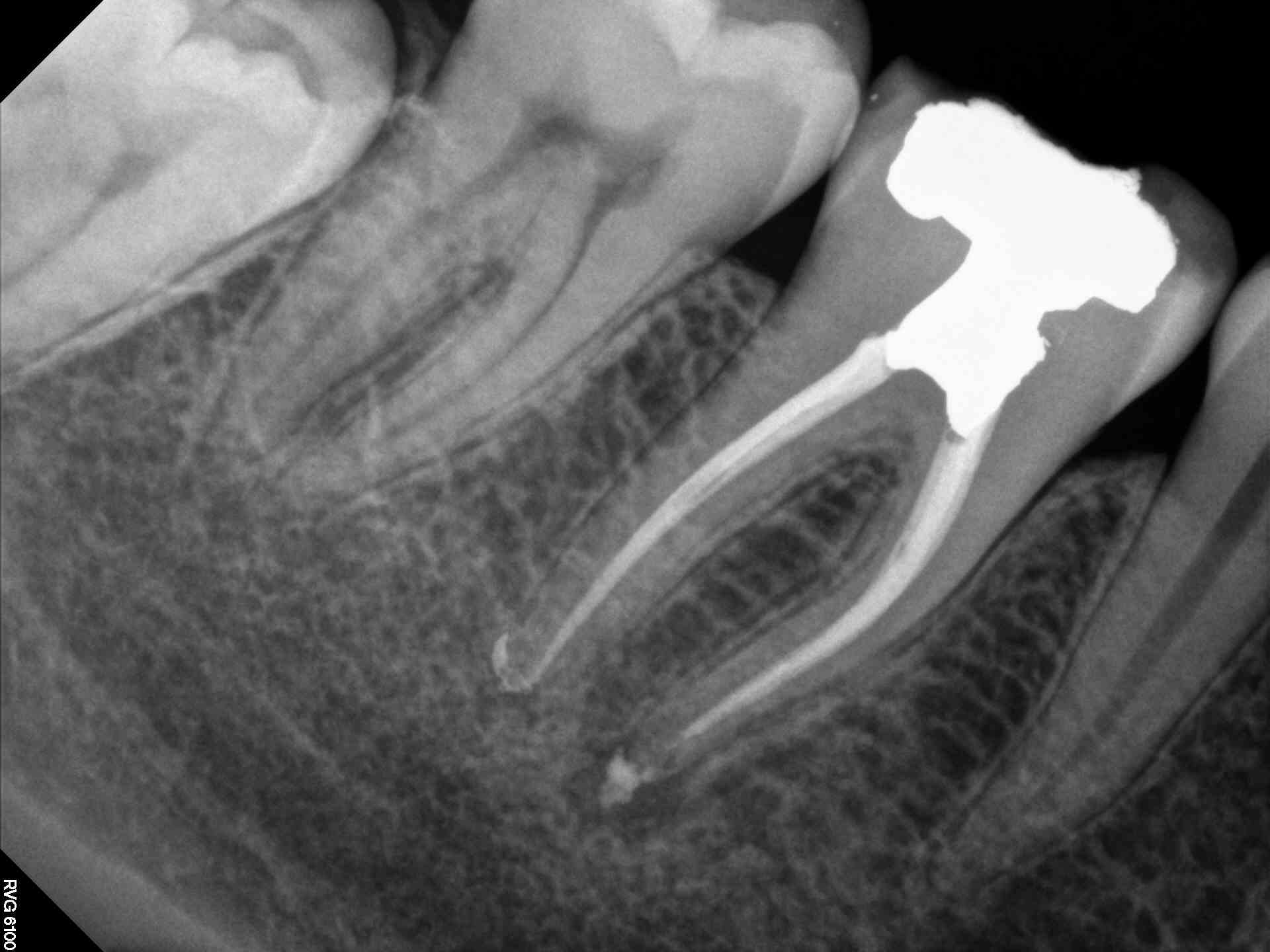 Molar Endodontic Therapy