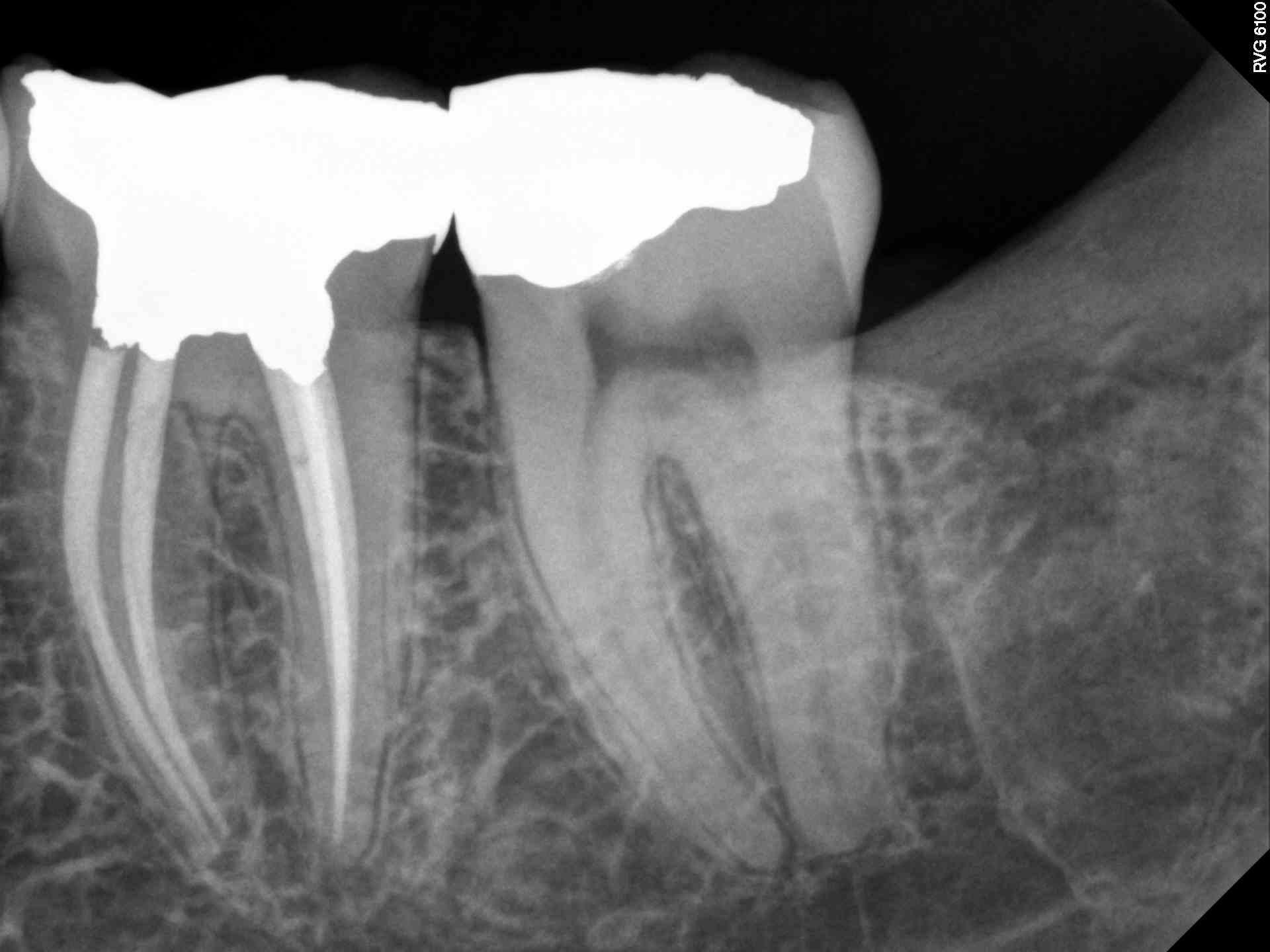 Severe Root Curvature