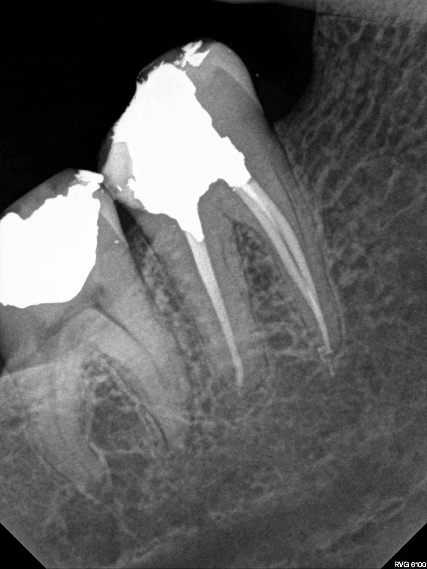 Canal Retreatment with Warm Vertical Seal