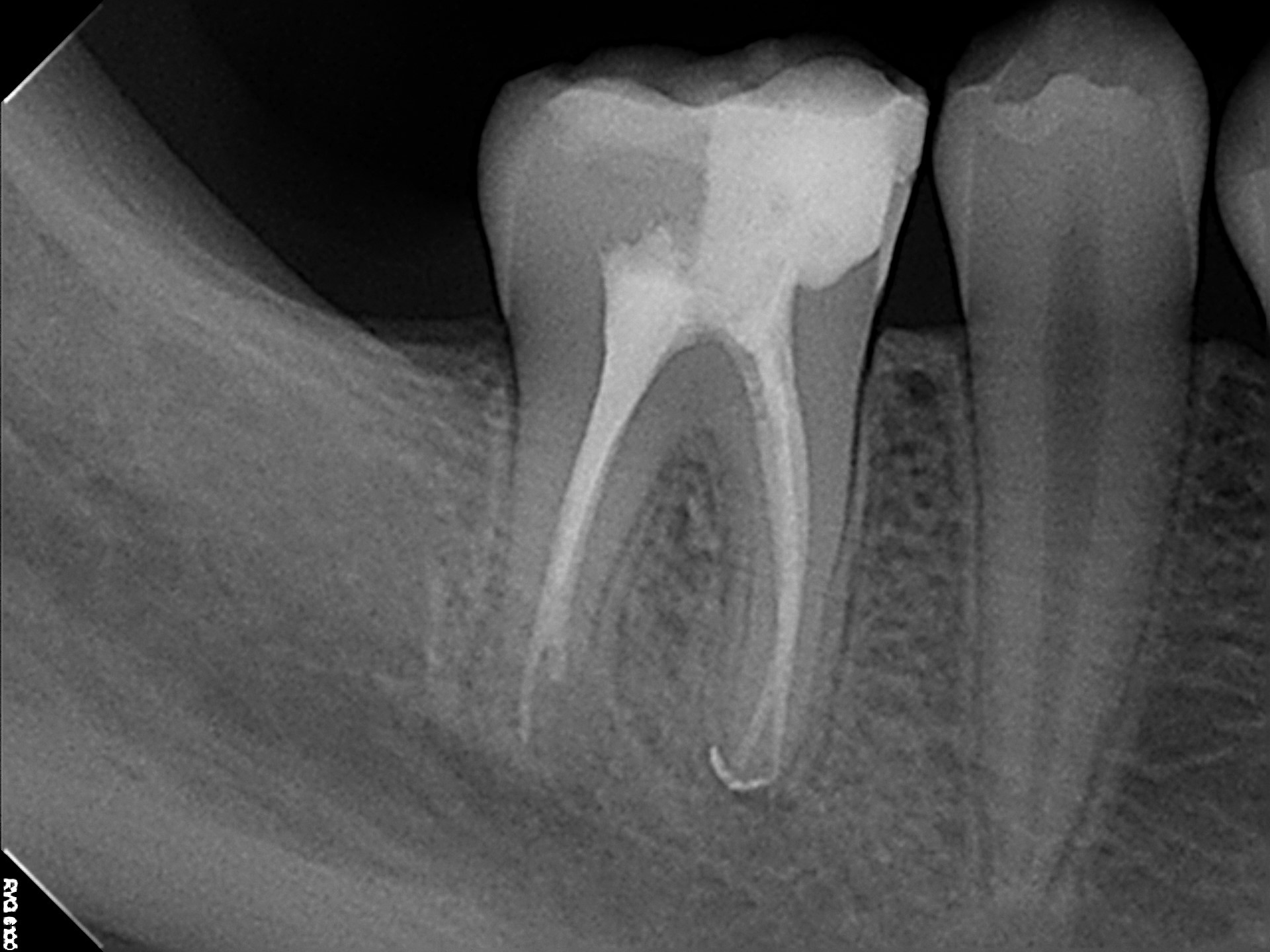 Precision Implant Fixture Placement