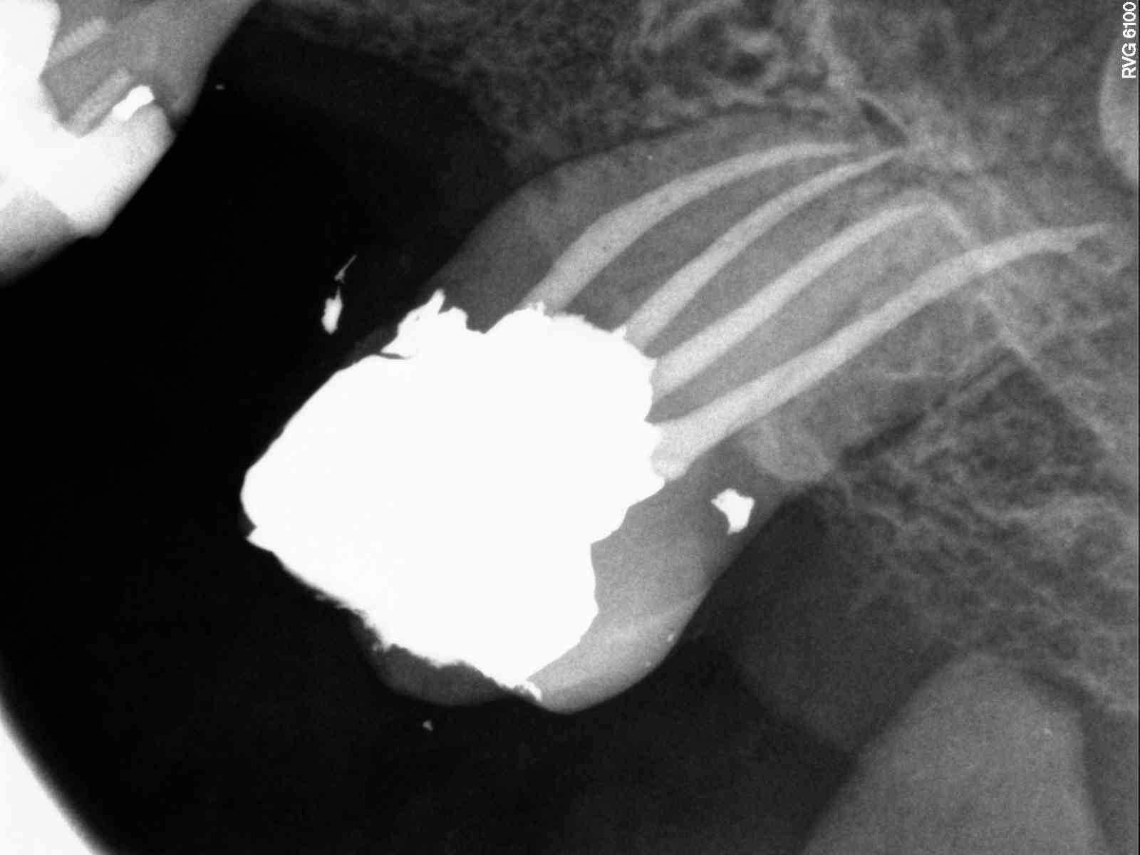 Anterior Dental Trauma Healing