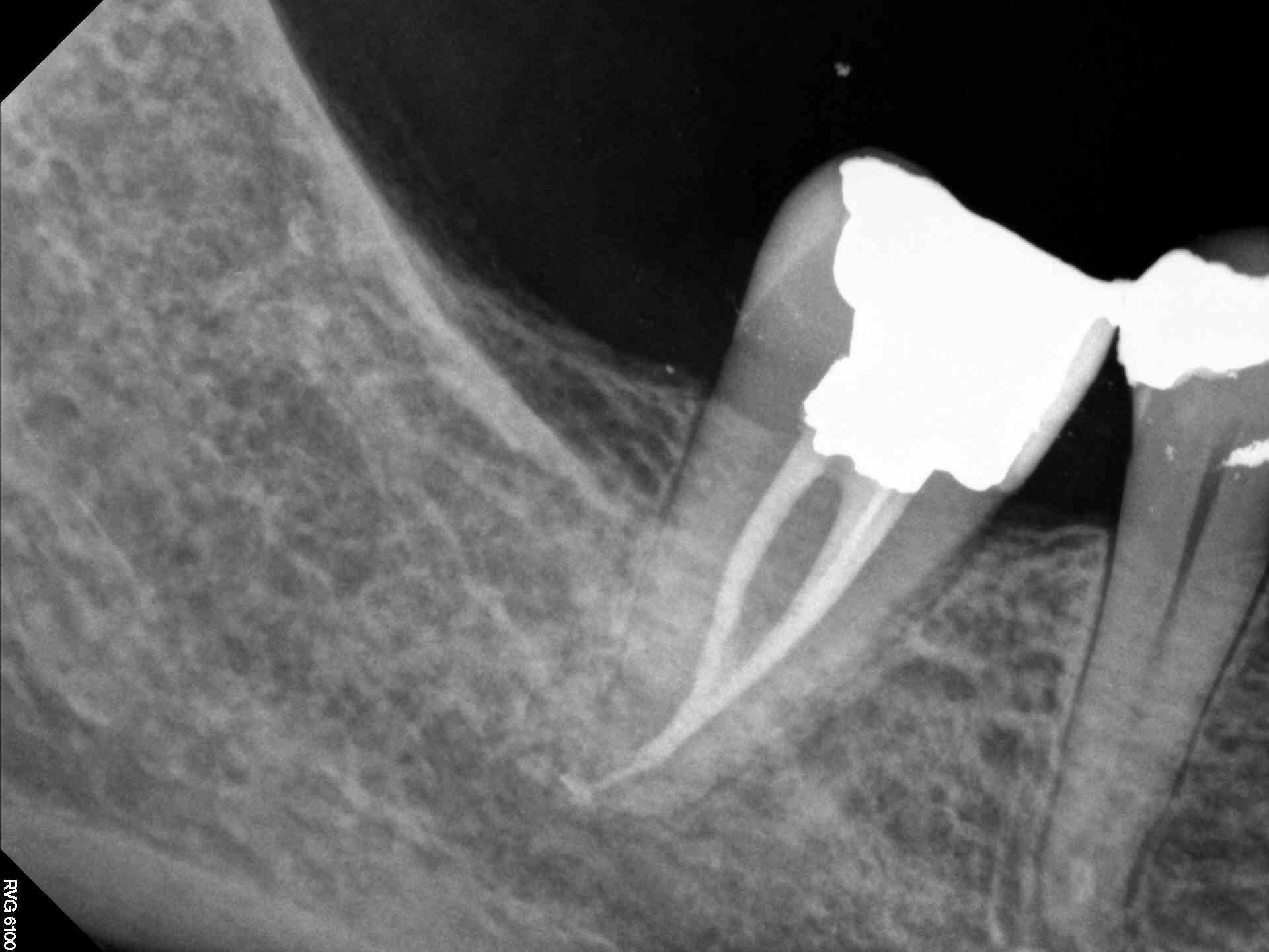 Multi-Canal Lower Molar