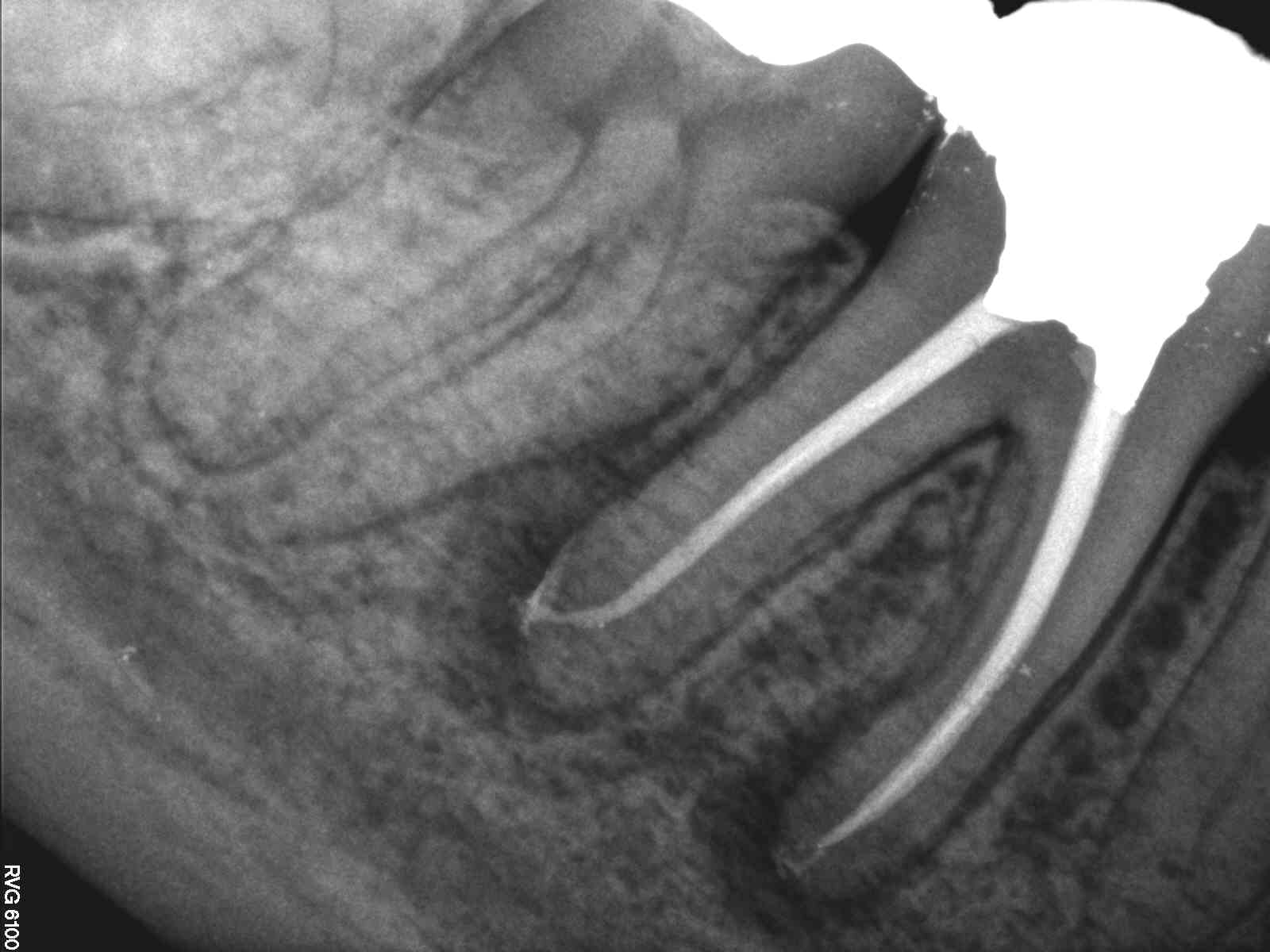 Calcified Canal Management