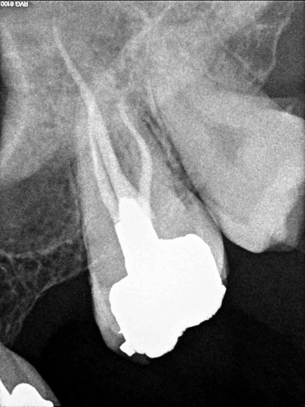 Apical Microsurgery Case