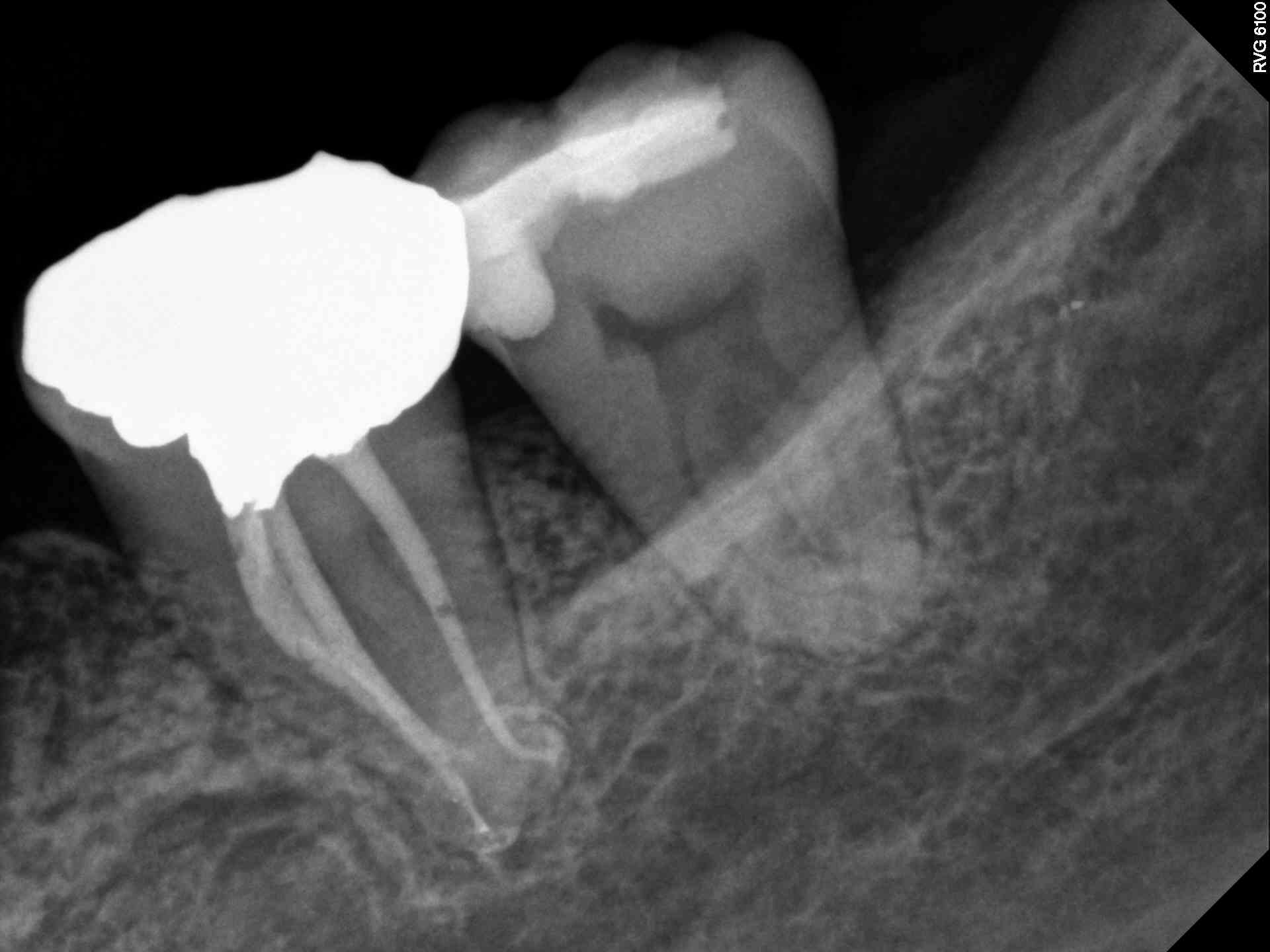 Apical Healing Radiograph