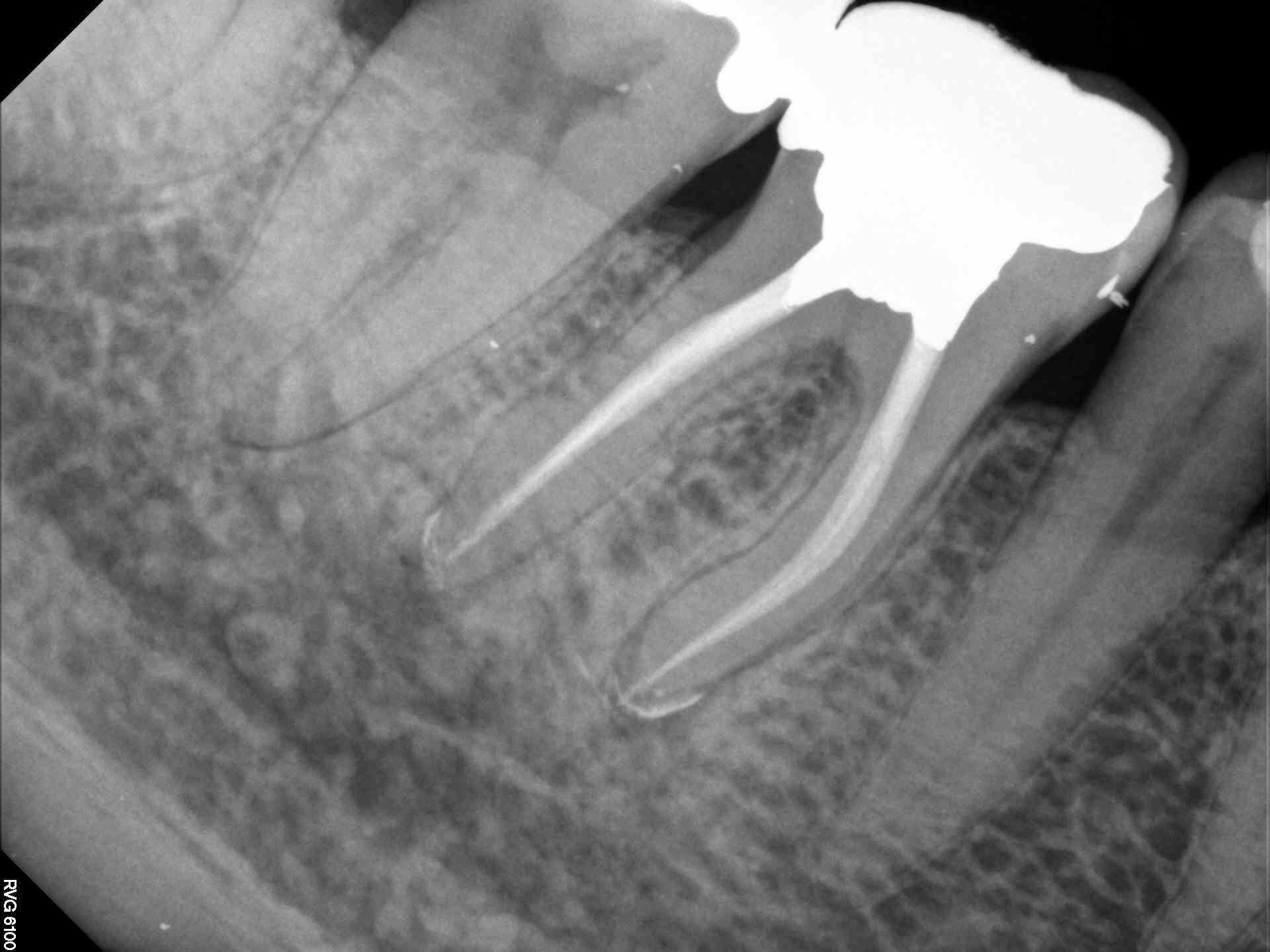 Curved Mesial Root Therapy