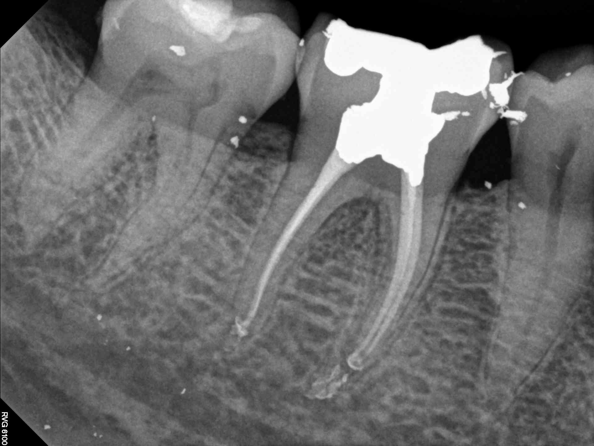 Upper Molar MB2 Canal