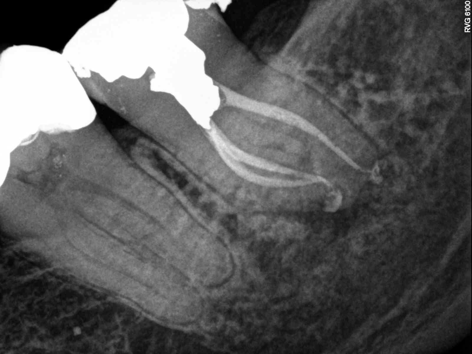 Microscope-Guided Canal Location