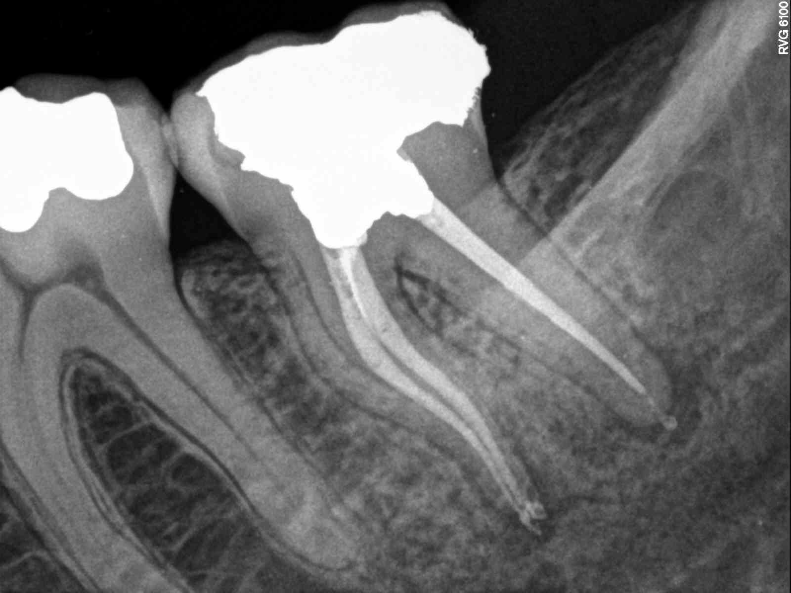 Bicuspid Retreatment