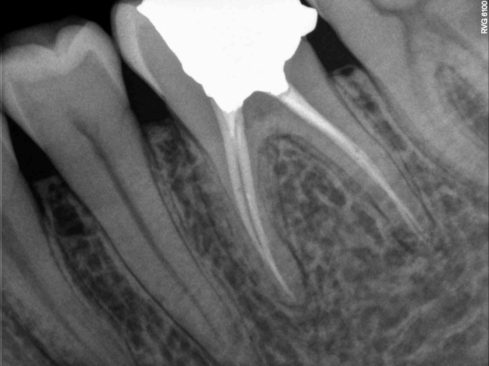 Mandibular Molar Obturation