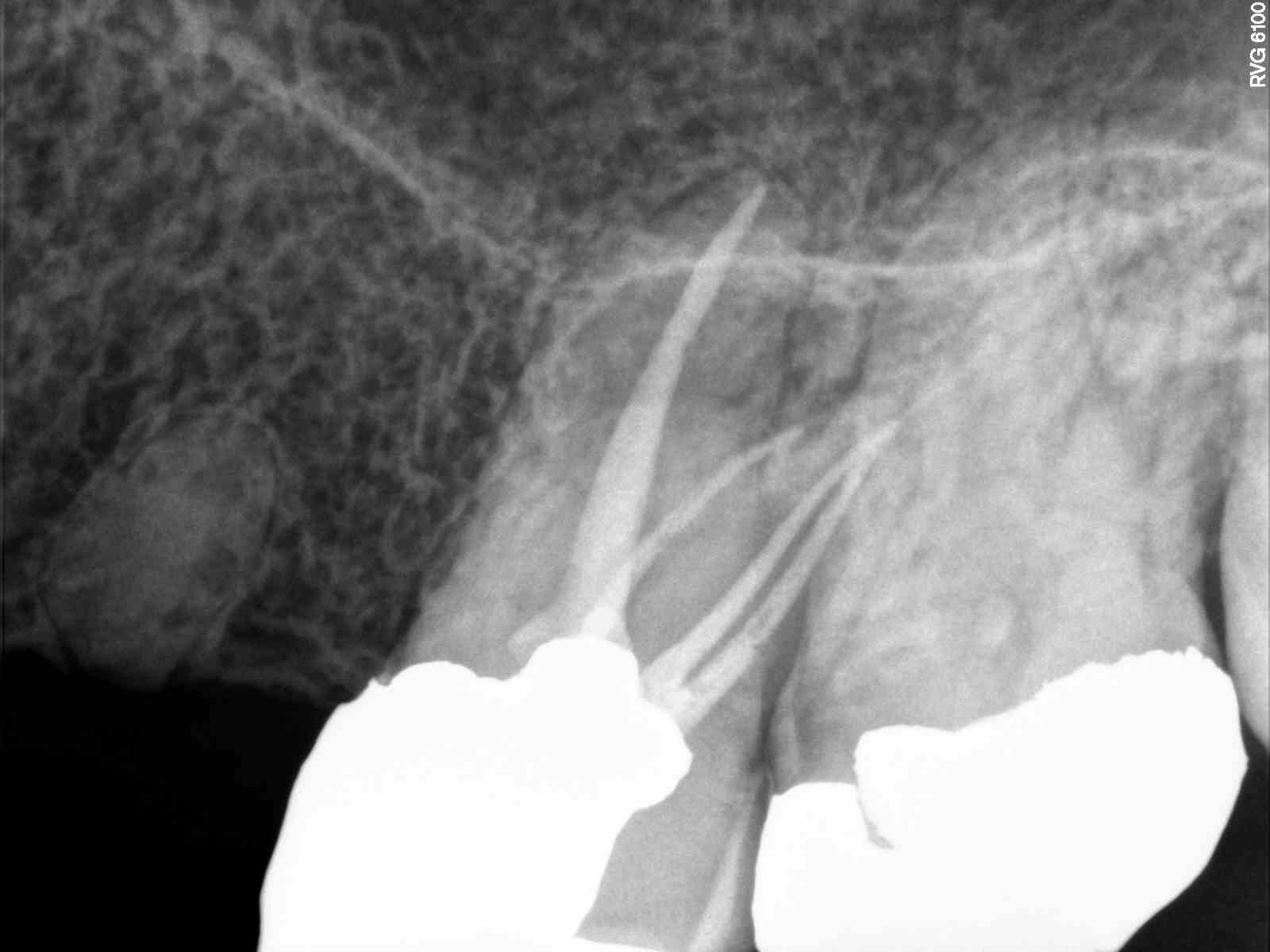 Apical Seal & Post Recovery