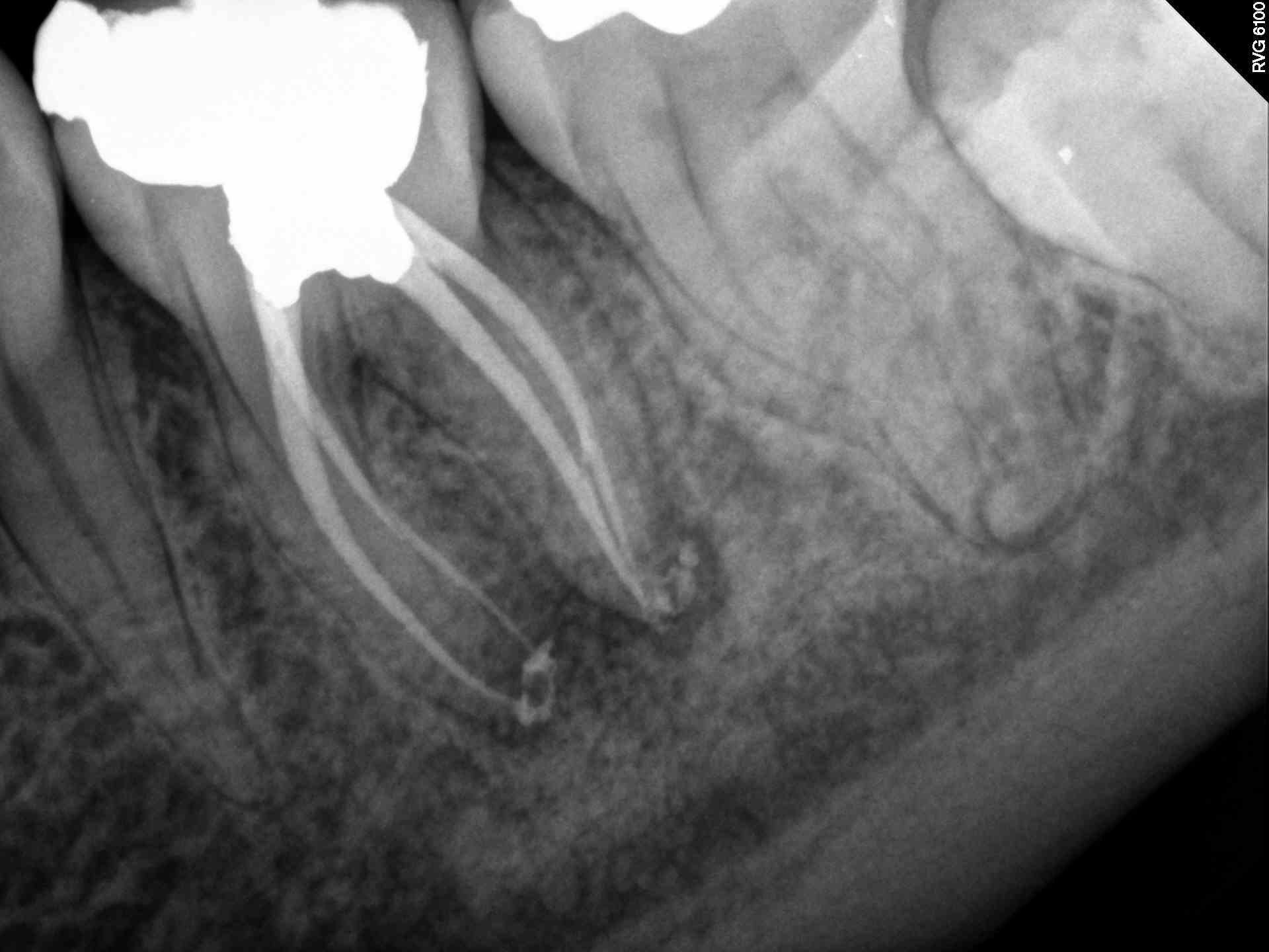 Periapical Lesion Recovery