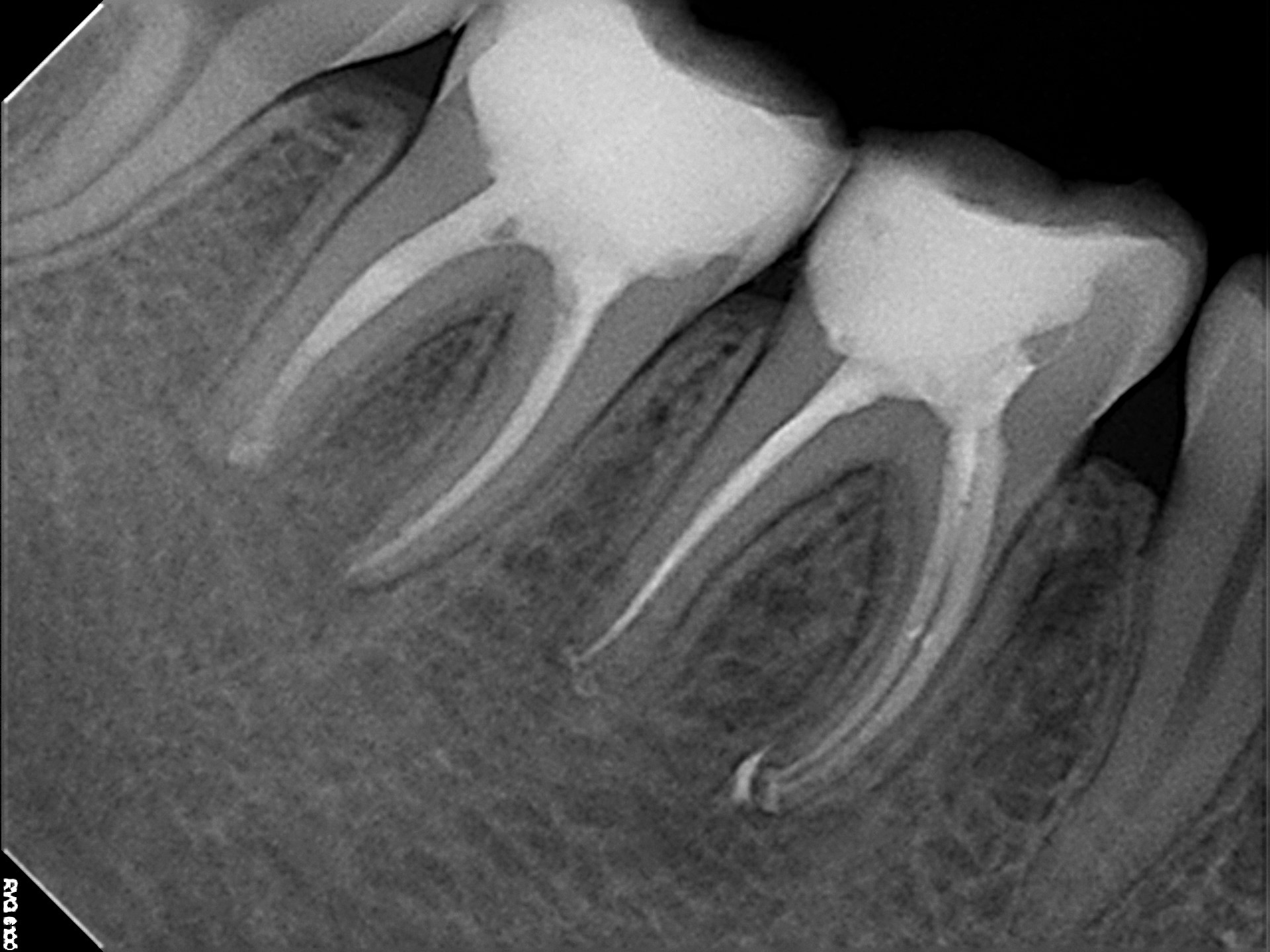 Multi-Unit Implant Case