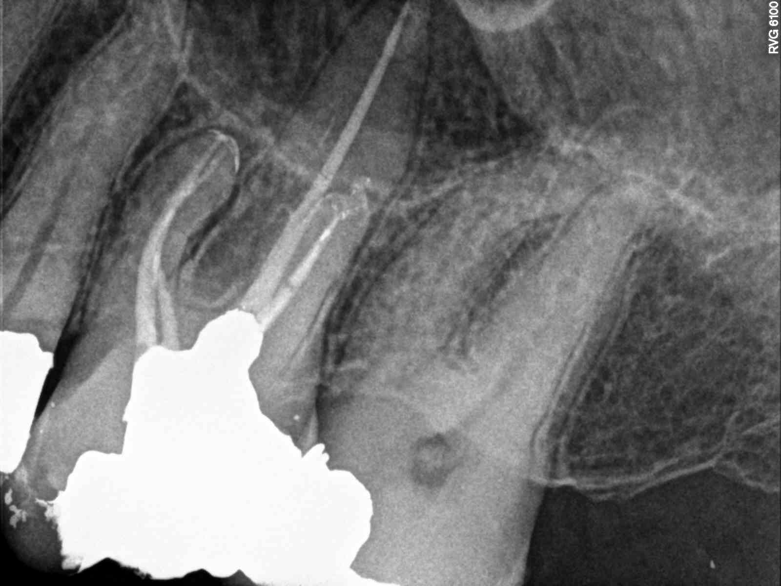 Maxillary Molar Endodontics