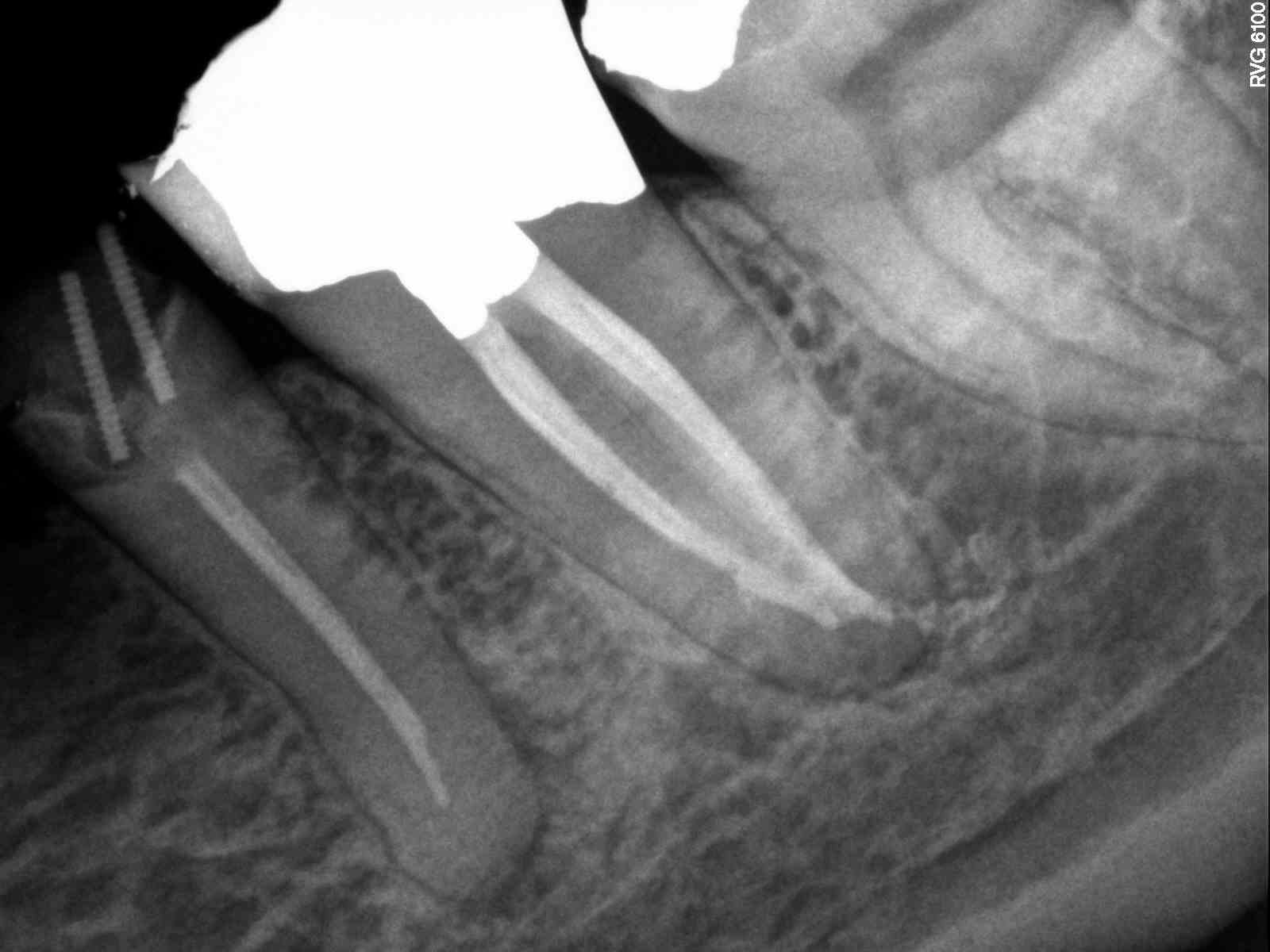 Curved Mesial Canal Case