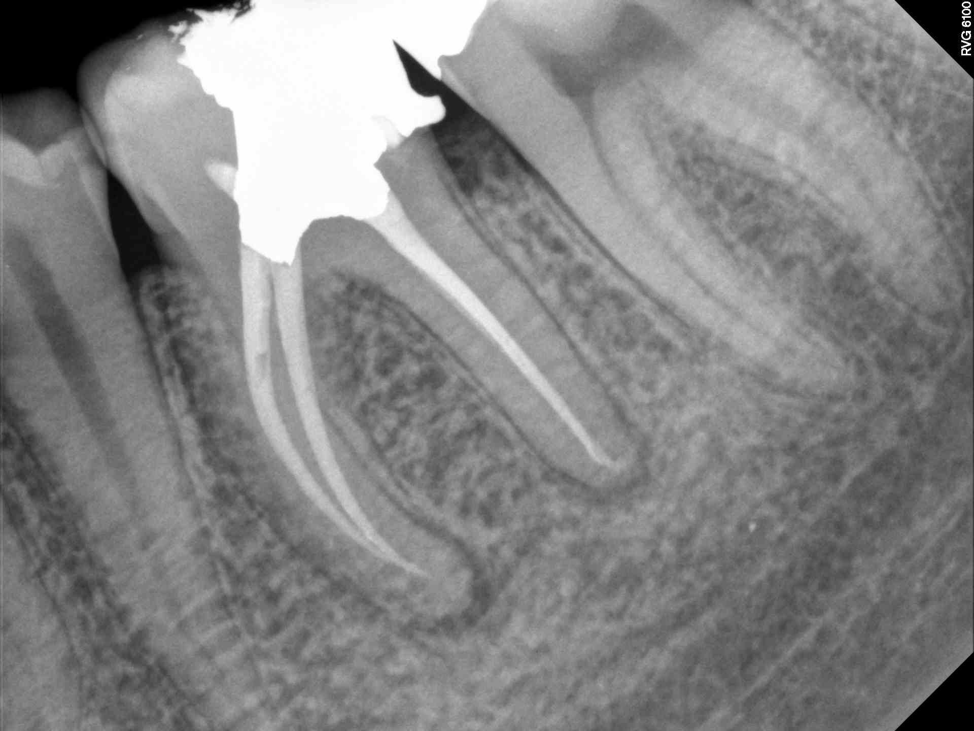 Bicuspid Root Canal Therapy