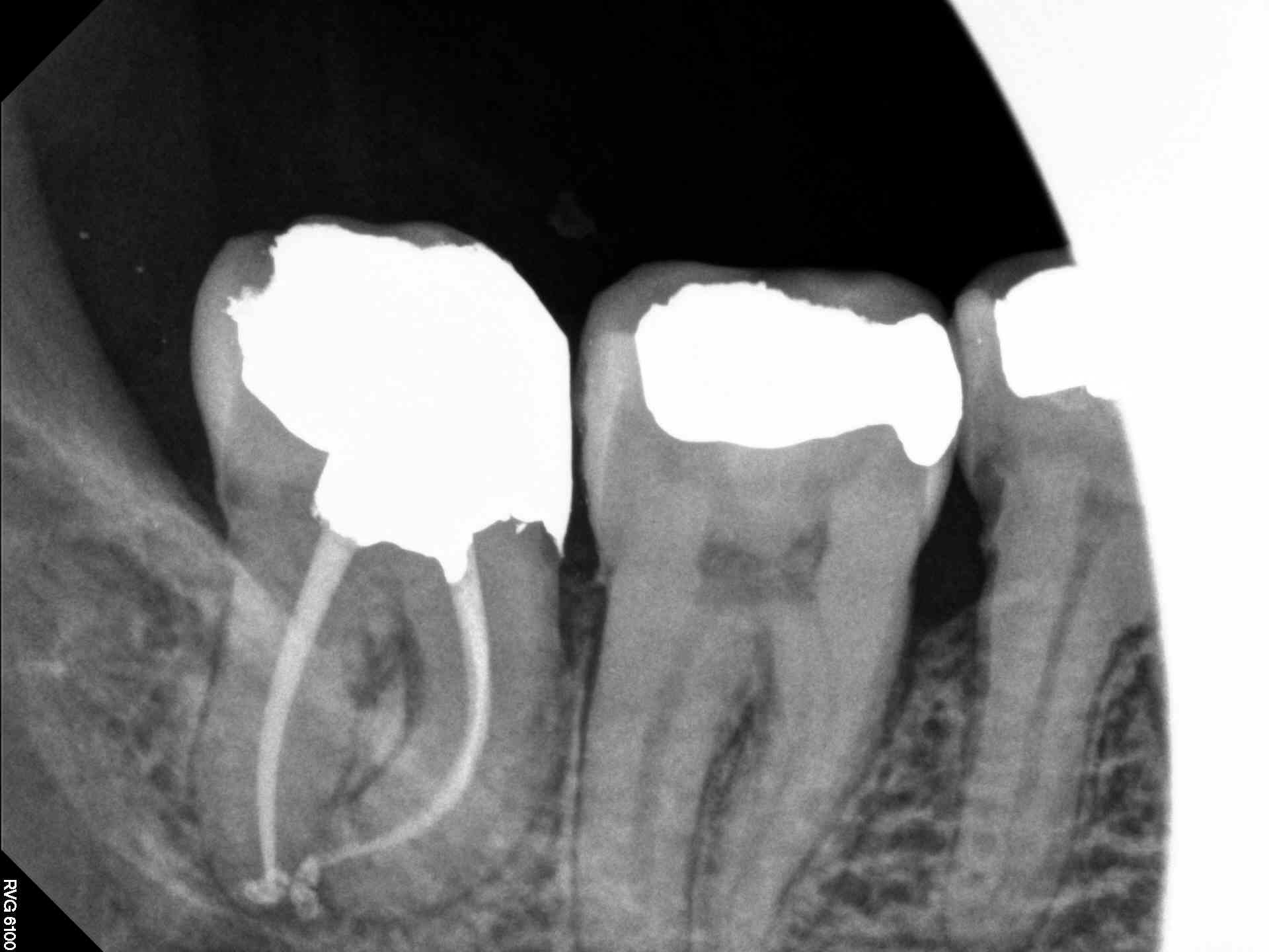 Dense Root Canal Condensation