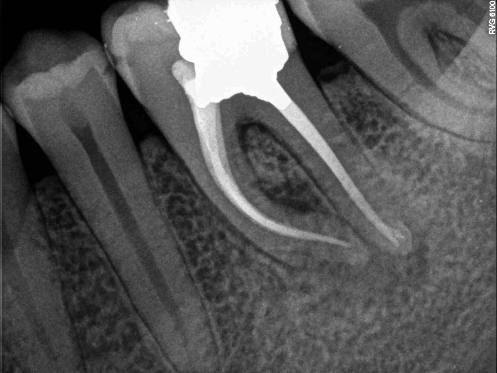Complex Canal Anatomy