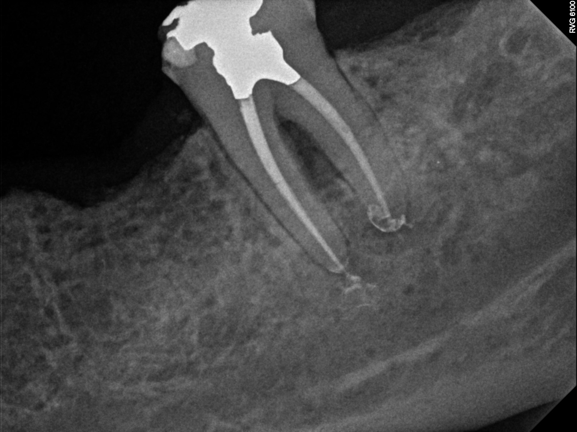Implant Osseointegration Radiograph