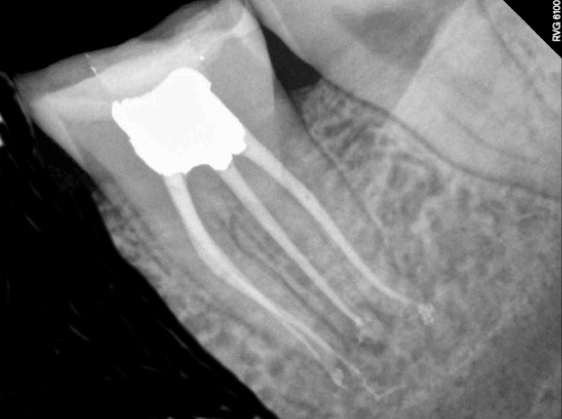 Radix Entomolaris Supernumerary Root